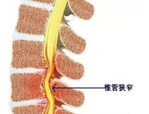 椎管狭窄症